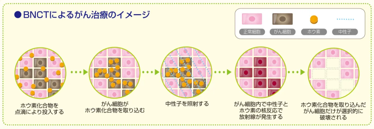 BNCTによるがん治療のイメージ