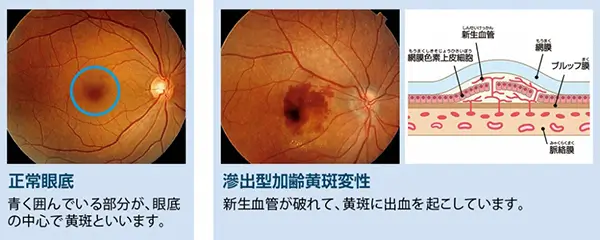 加齢性黄斑変性症、網膜中心静脈閉塞症、糖尿病網膜症のレーザー