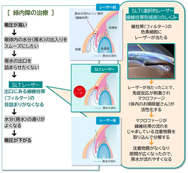 選択的レーザー線維柱帯形成術